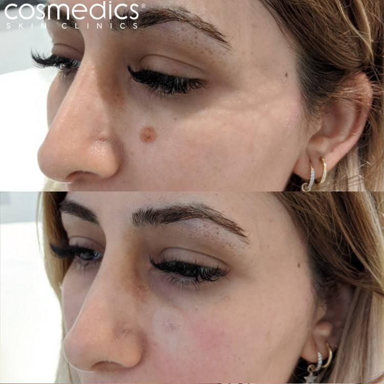 Before and after facial mole removal