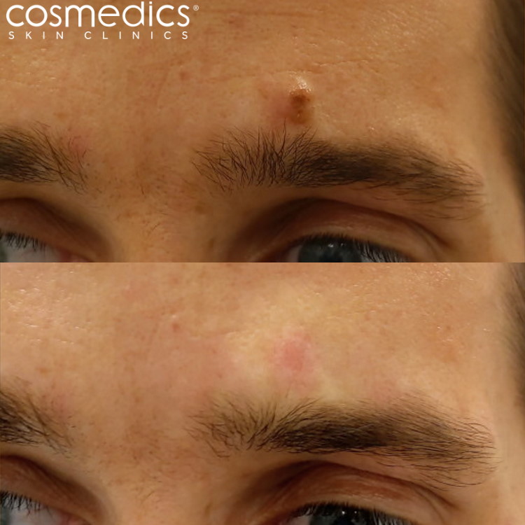 Before and after results photos Cosmedics Skin Clinics