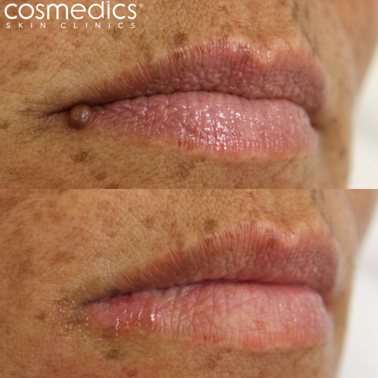 Mole on lip removal results