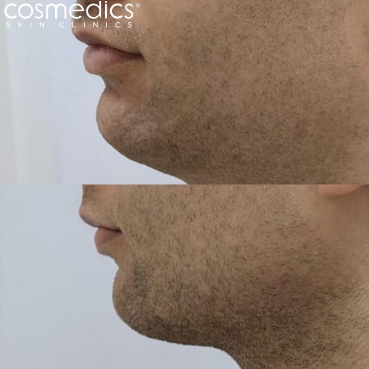 BELKYRA male double chin treatment results