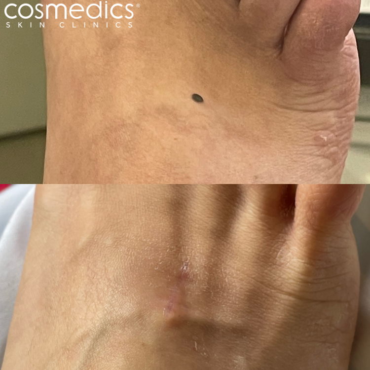 Foot mole removal results