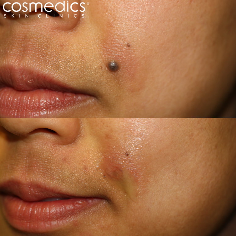 mole removal cheek before after