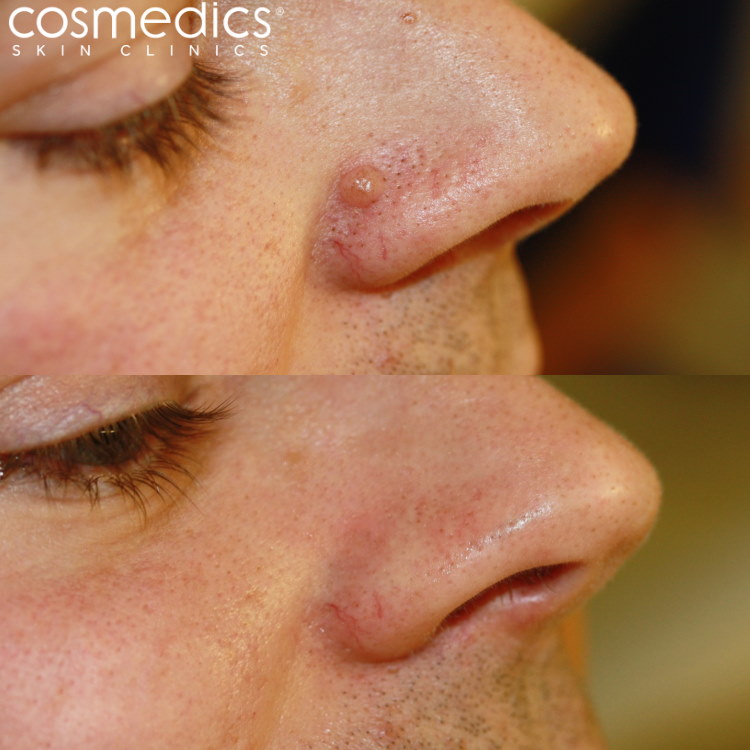 nose mole removal before after