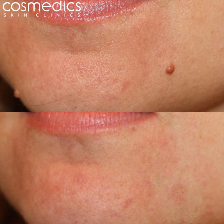 chin mole removal before after