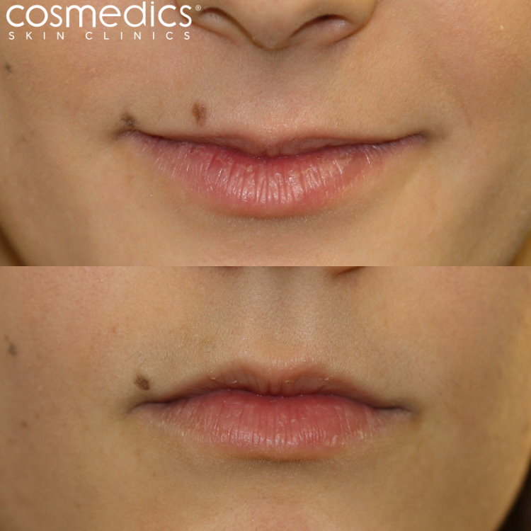 mole removal lips before after