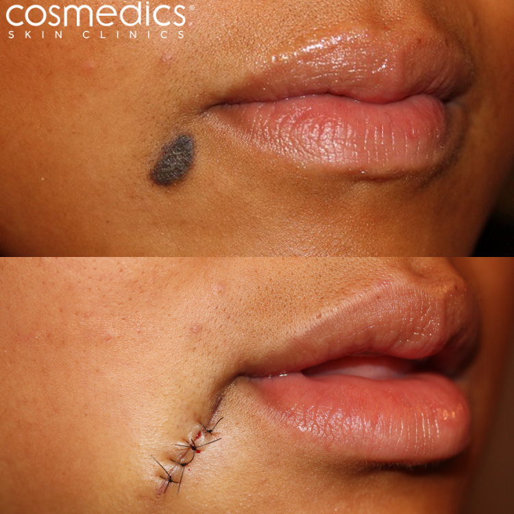 Recovery mole excision Mole Removal