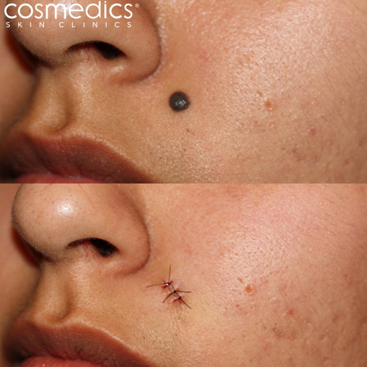 facial mole before after surgery