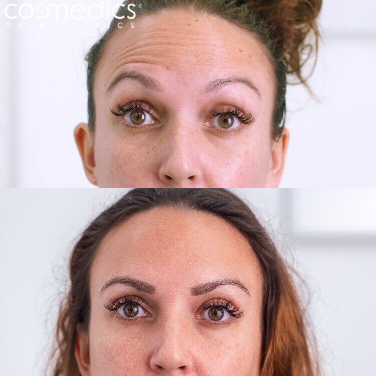 BOTOX Forehead Before & After Chloe