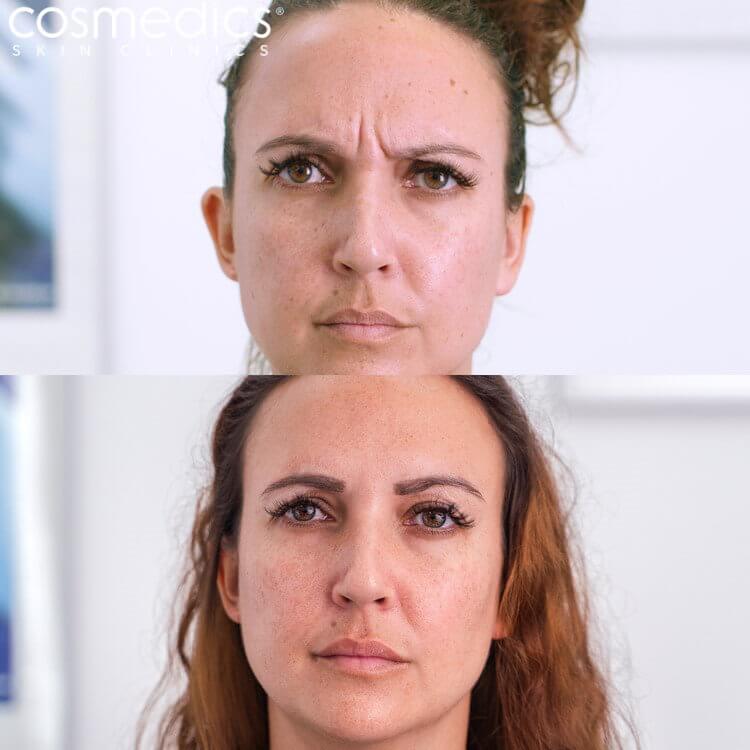 BOTOX Frown Before & After Chloe