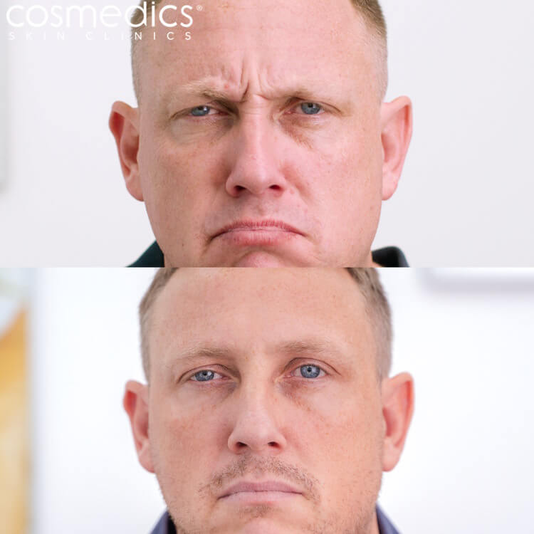 Male BOTOX Frown Lines Before & After - Matt