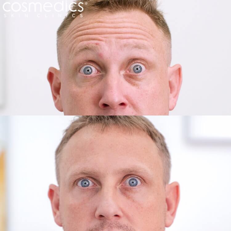 Male BOTOX Forehead Lines Before & After - Matt