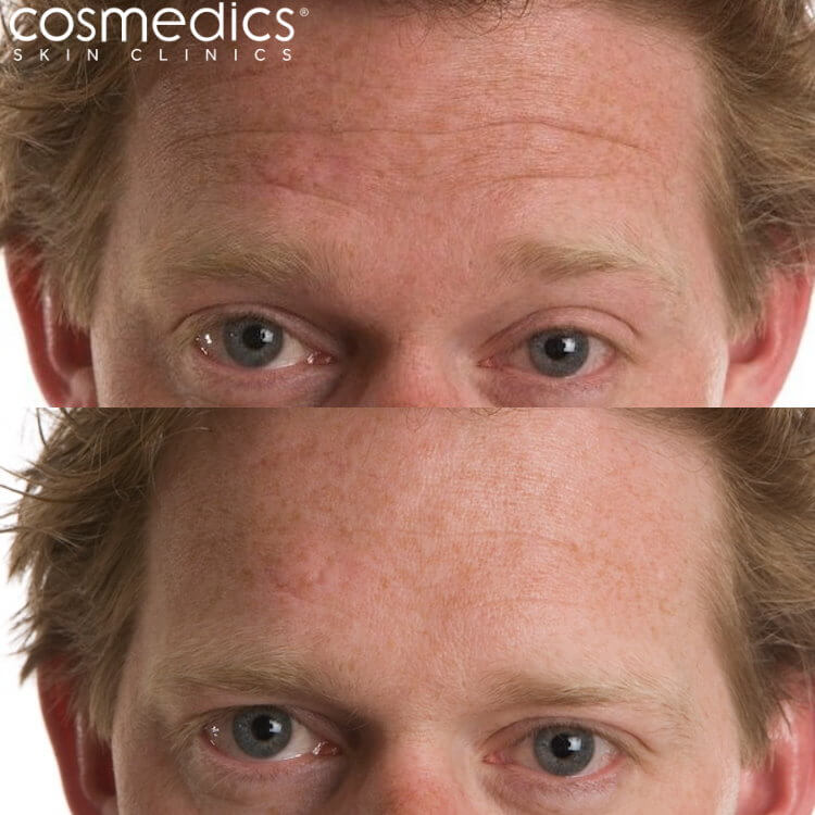 Before and After BOTOX For Men