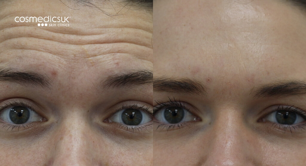 Botox forehead results