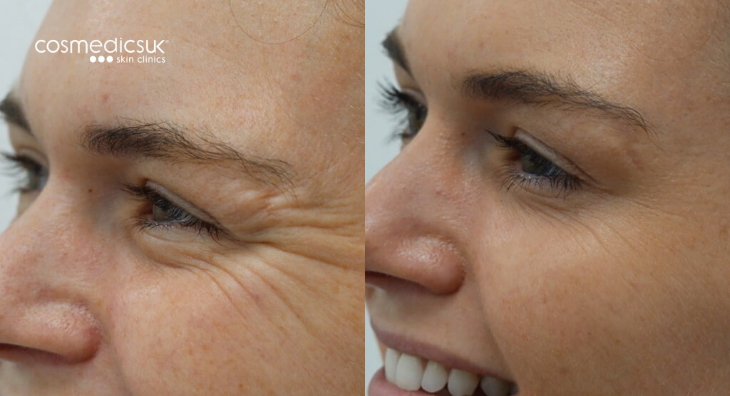 Botox crows feet results