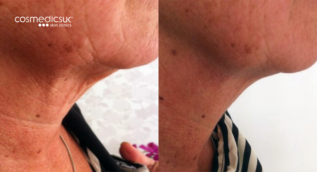 clearlift before and after chin lift