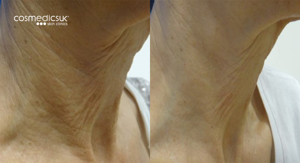 Clearlift laser before and after