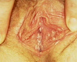 vaginal genital warts inside