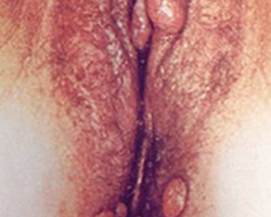 vaginal genital warts outside