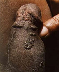 penile warts in detail