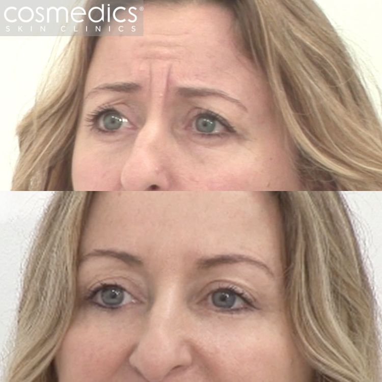 BOTOX injection for wrinkles