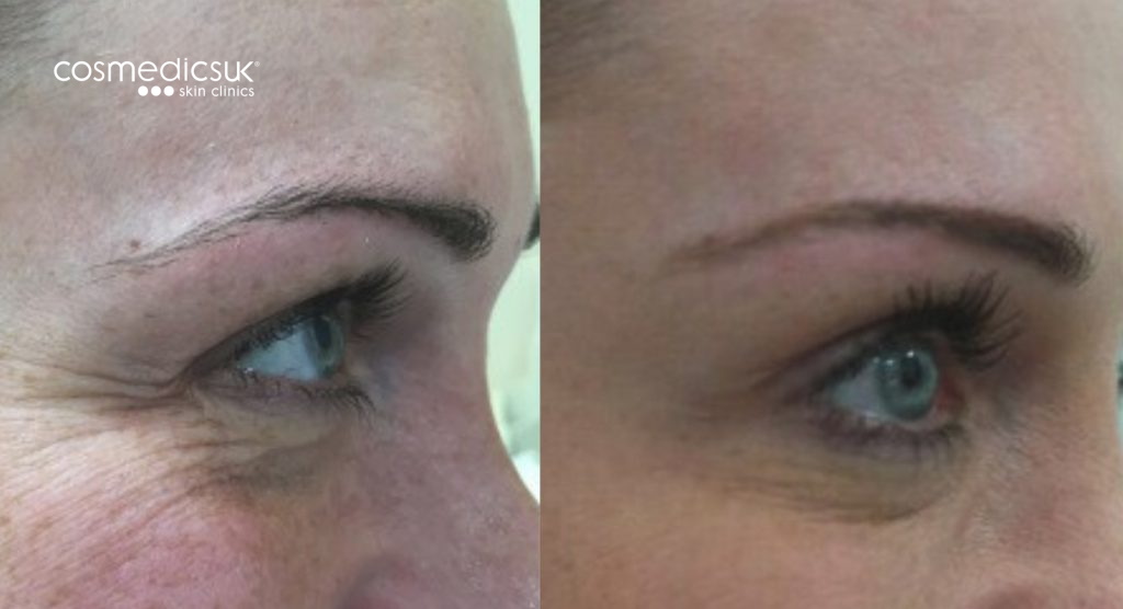 BOTOX® crows feet treatment results