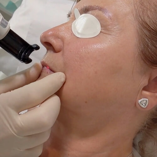 Lip Venous Lake Blemish - Laser Removal Demo at our London Clinic