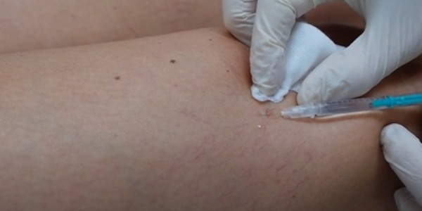 Cosmedics Sclerotherapy Treatment for the Thighs