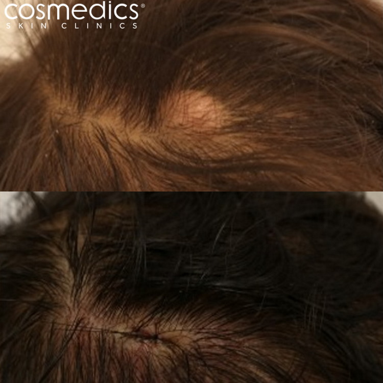 before and after scalp cyst removal London
