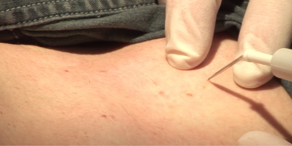 Skin Tag Removal by Microcautery Laser