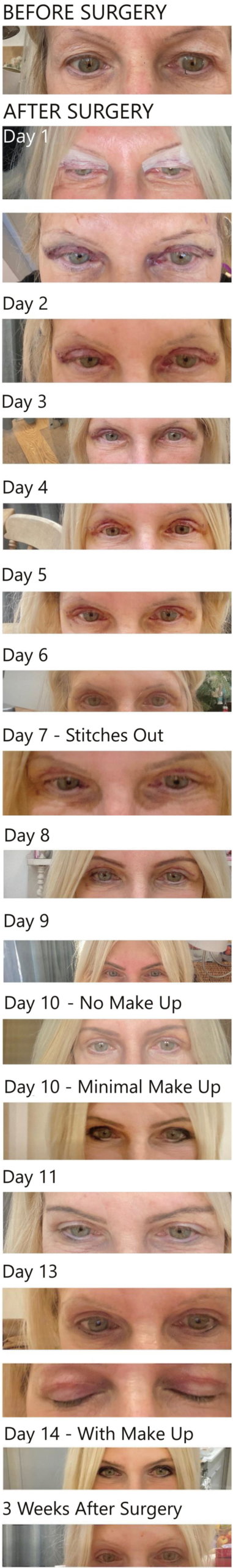 upper blepharoplasty step by step recovery