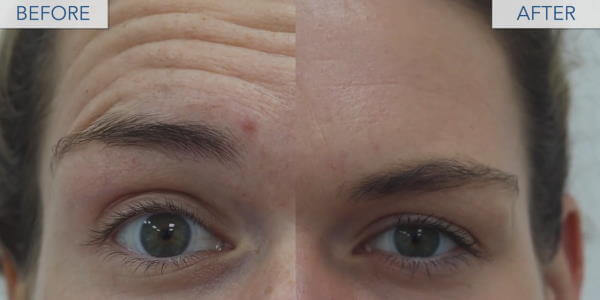 Before and After BOTOX anti-wrinkle treatment London