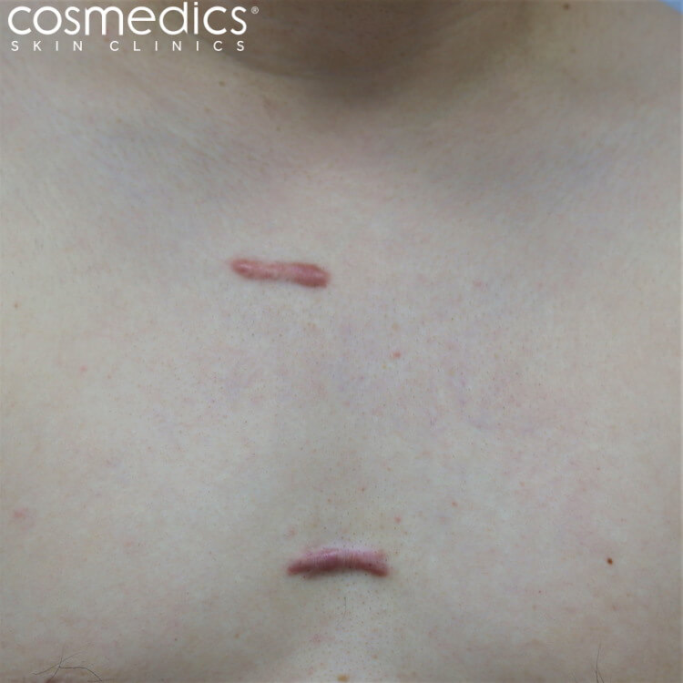 Typical keloid scars
