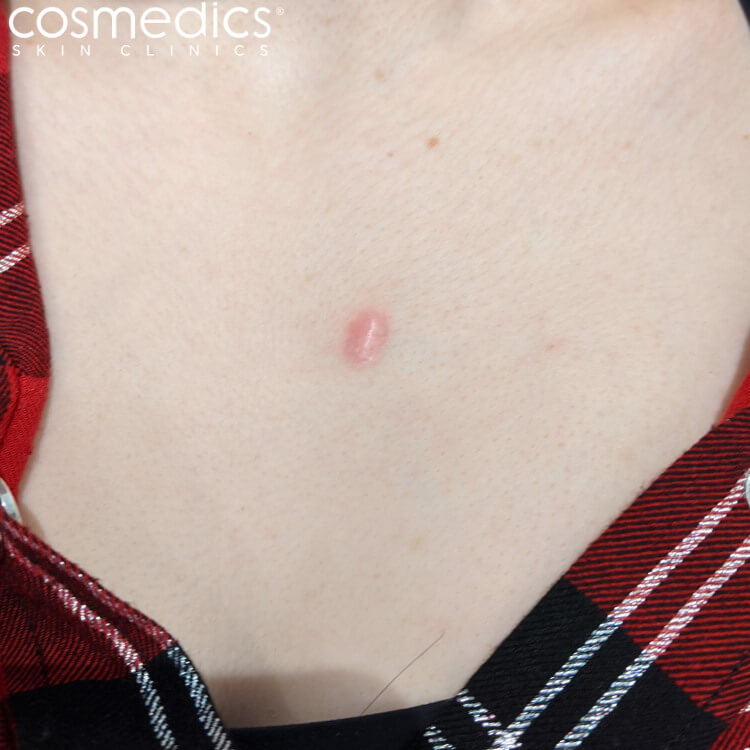Keloid scar on chest