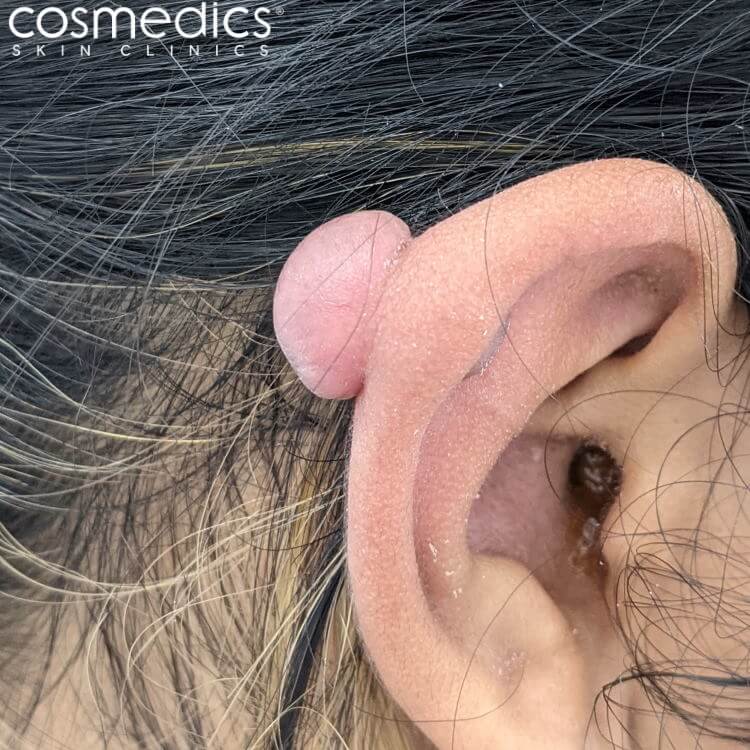 Keloid scar growth on ear