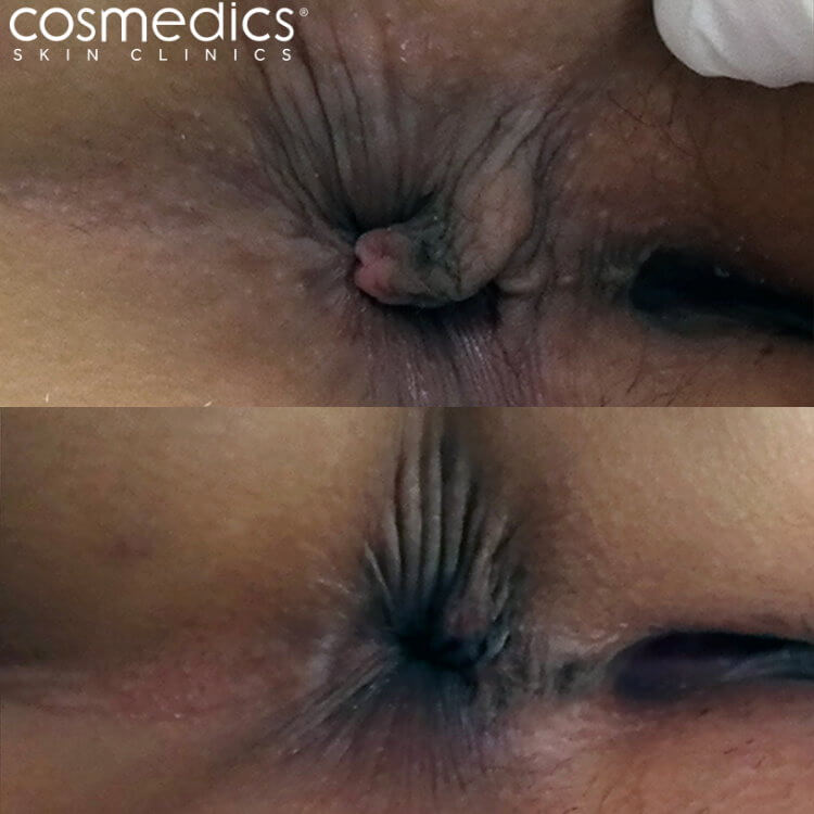 Anal skin tag treatment before after