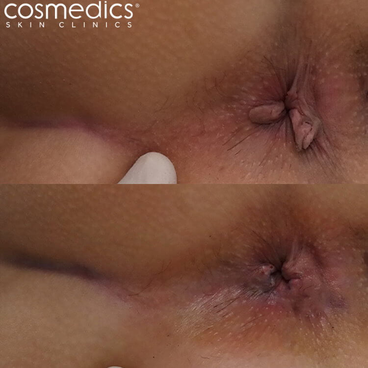 Anal skin tag before after