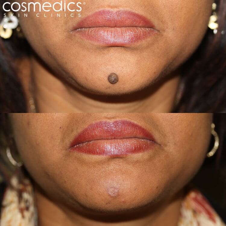 Large mole on chin removal results