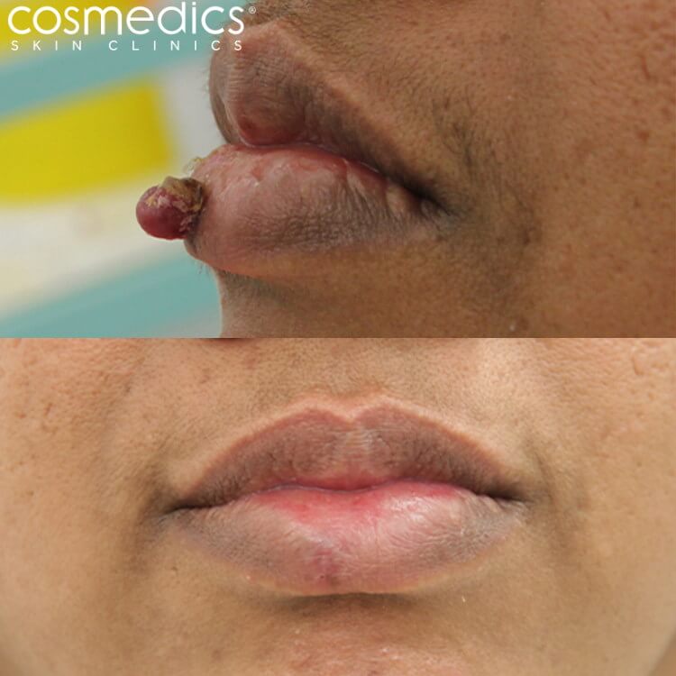 lip cystic mole removal results