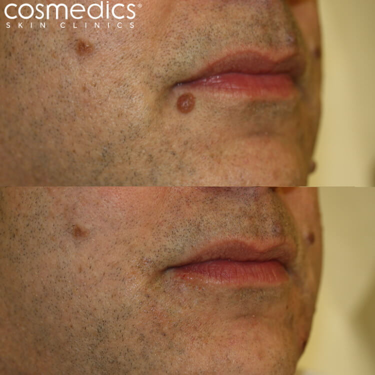 mole on lip removal surgery and laser results
