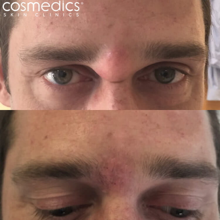 infected sebaceous cyst removal before and after