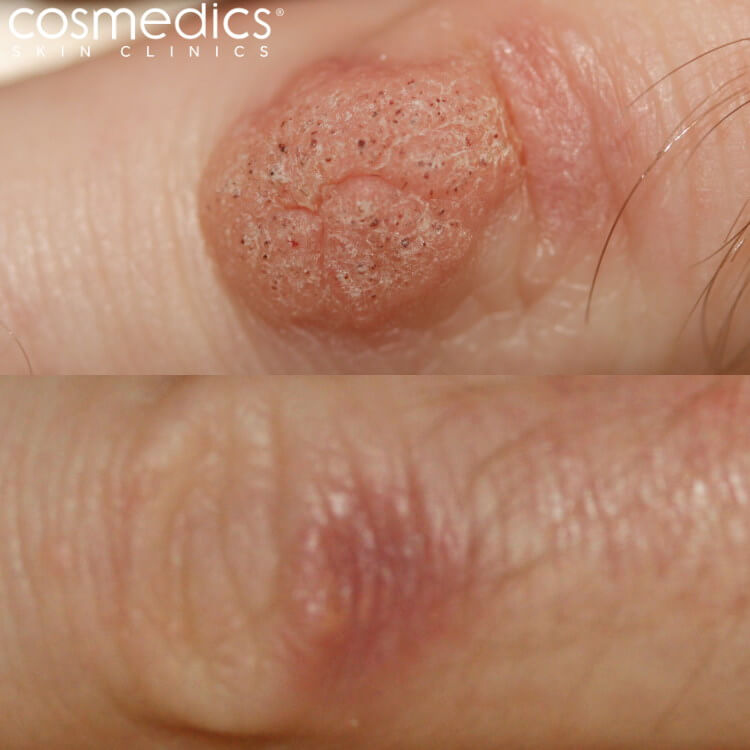 finger wart removal before and after