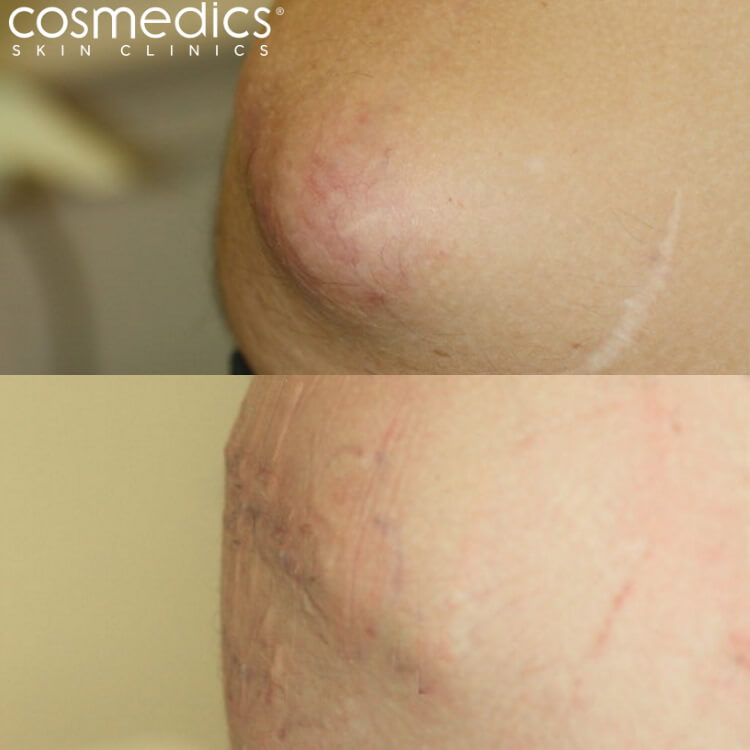 sebaceous cyst abdomen large - removal results