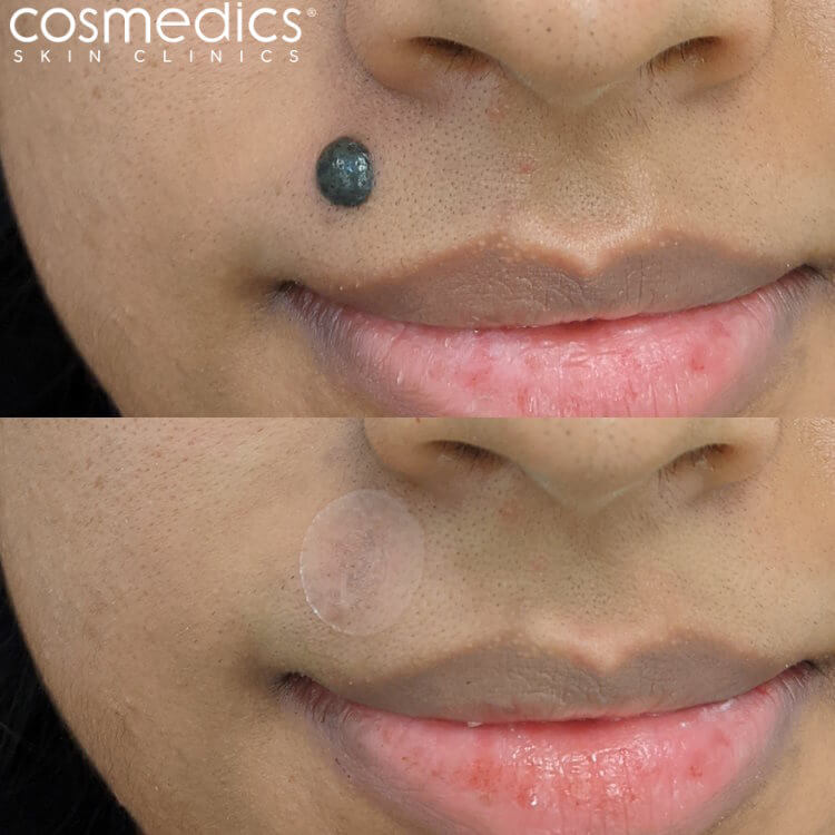before after large upper lip mole removal