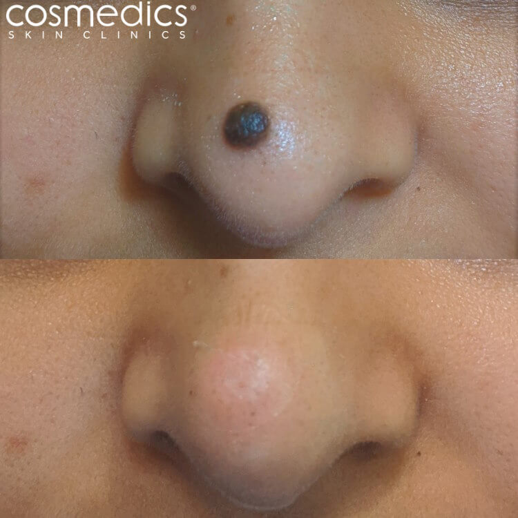 before after large nose mole removal