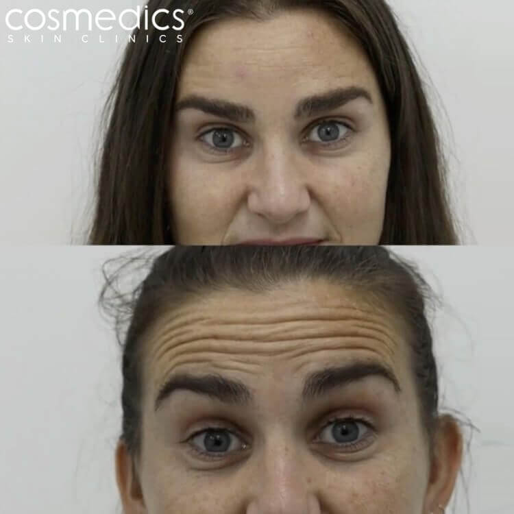 Botox at Cosmedics