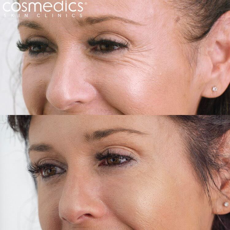 BOTOX Crows Feet Before & After Abby