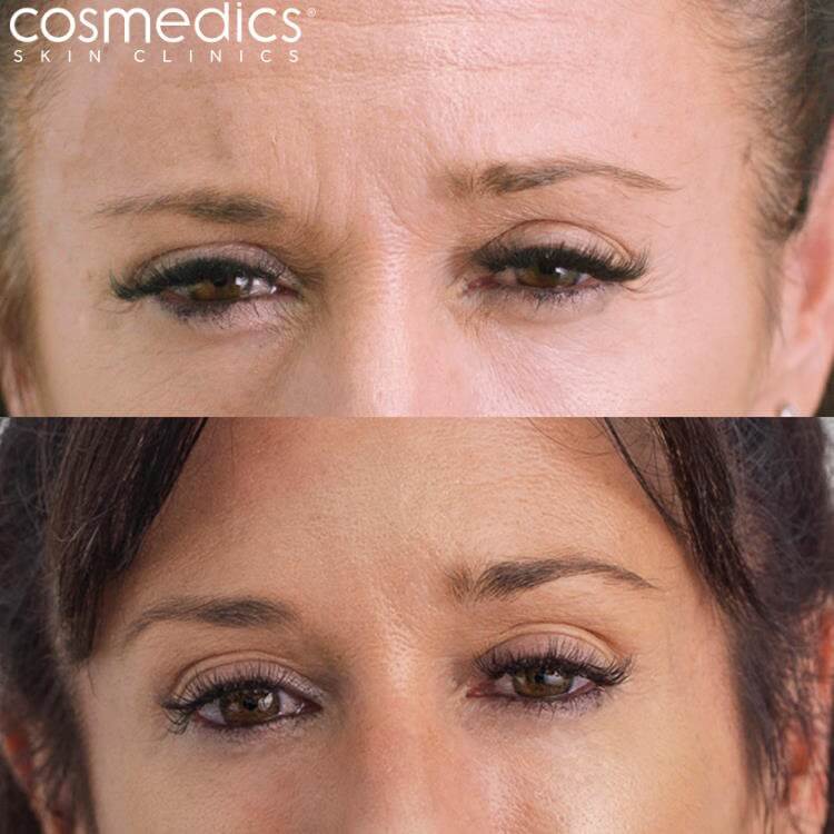 BOTOX Frown Line Before & After Abby