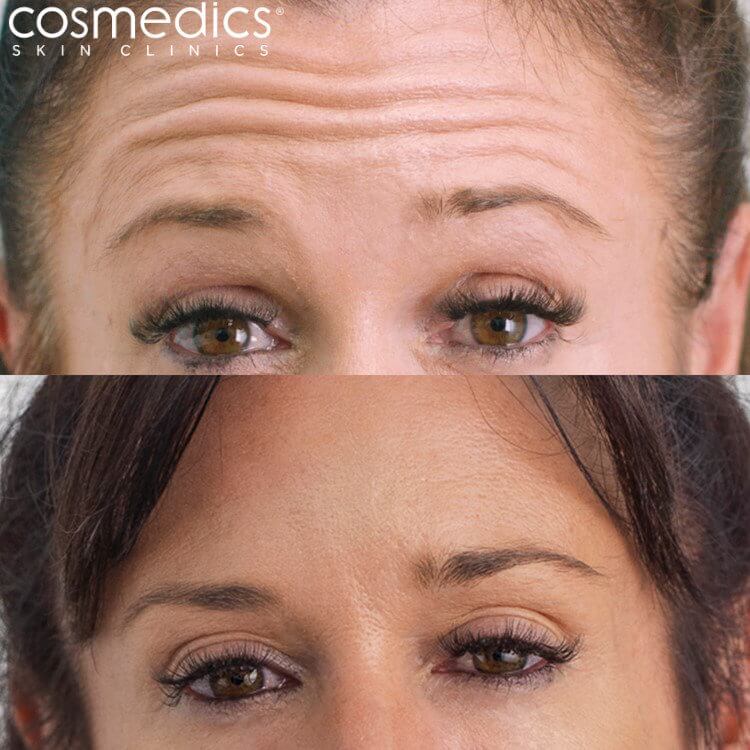 BOTOX Forehead Before & After Abby