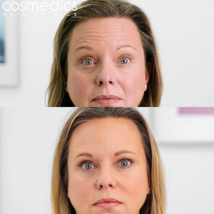Before & After BOTOX Forehead Line Treatment