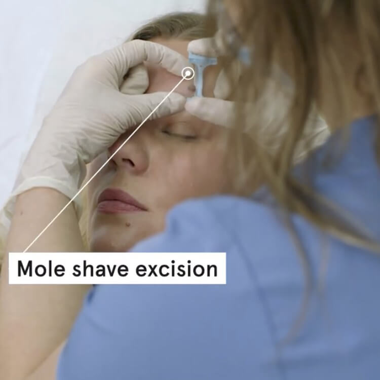 Esther facial mole removal excision